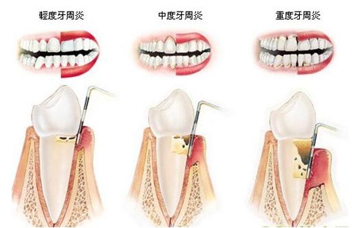 有了这些症状，要小心牙周炎了，小心引发牙疼直接导致牙齿松动