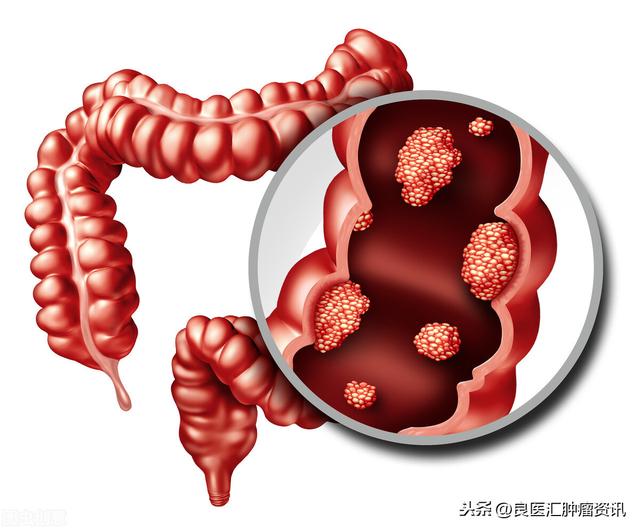 担心！直肠癌的误诊率近70%，我们该如何避免被误诊？