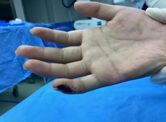 28岁小伙上肢缺血险坏死，医生以大隐静脉移植重建血管通路让他“绝处逢生”