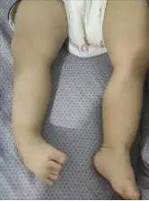 小酒窝|每年都有一些父母，因不知道这个疾病可治愈，而放弃胎儿生命