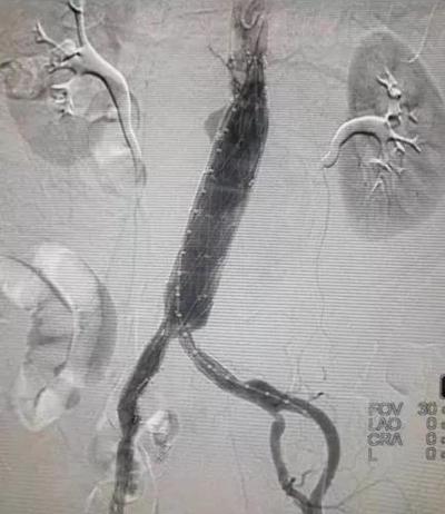 患者|长治二院成功完成一例腹主动脉瘤微创腔内