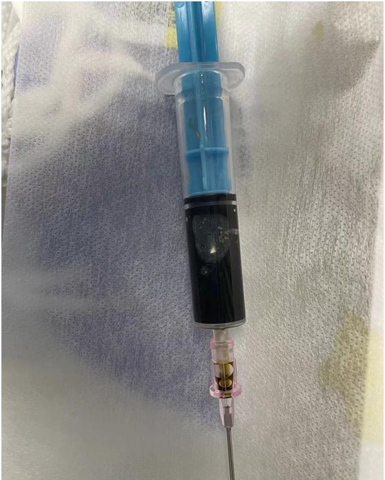 超声|胆囊炎急性发作却不能手术怎么办？这个方法为他赢得手术机会