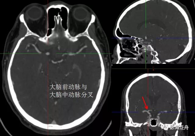 超实用的颈内动脉CTA分段