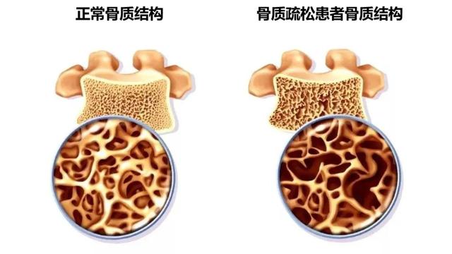 永春县总医院开展双能X线骨密度测定