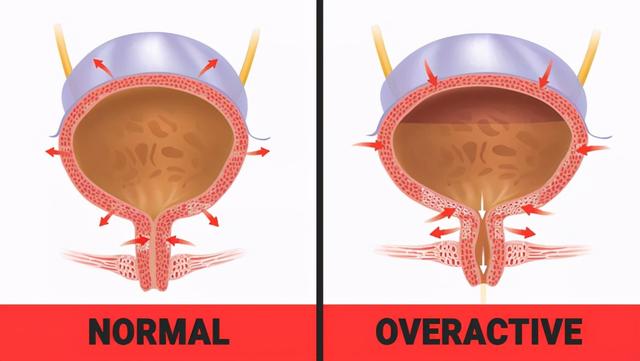 膀胱过度活动症迎来新疗法，有效减轻尿频、尿急、尿不尽症状