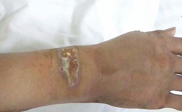 小心！被铁门夹伤未在意，竟恶化成了顽固性皮肤溃疡