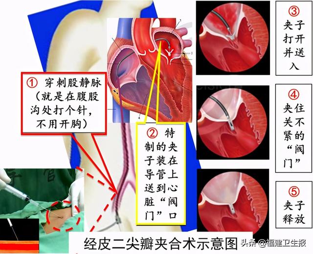 反流|88岁大爷心脏“阀门”关不紧，福建医生用一枚夹子救了他