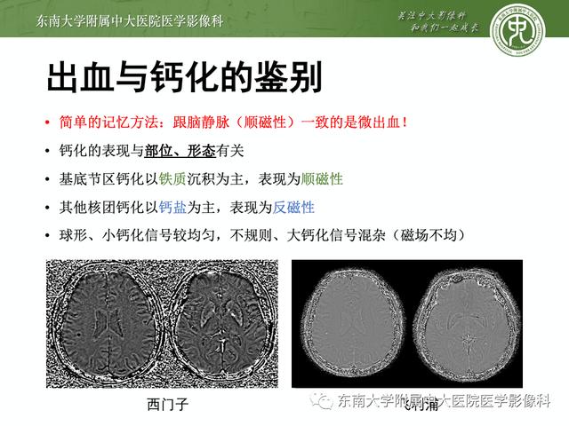 SWI的成像原理及相关病例随访