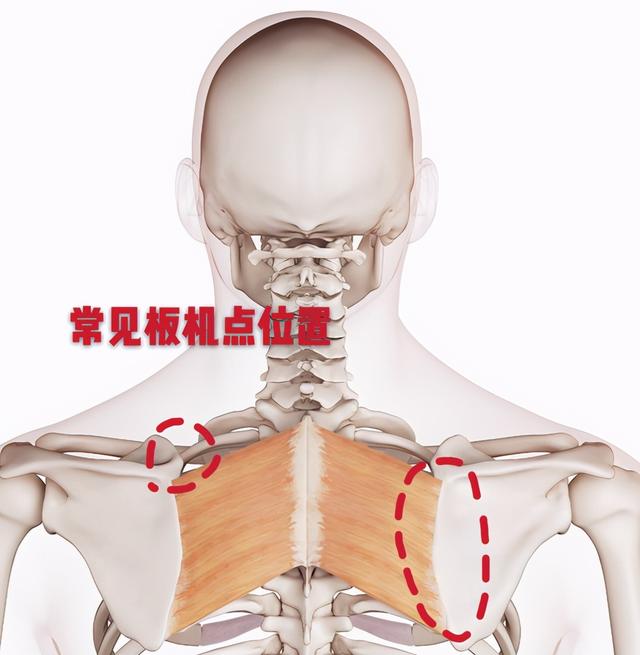 后背疼、紧、僵硬怕冷，是受凉导致的？医生辟谣，讲清肌筋膜炎