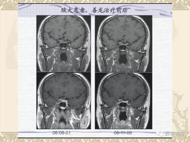 垂体病变的MRI诊断