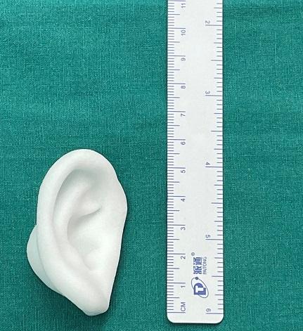 患儿|上海专家升级3D定制全耳廓 同步听力重建