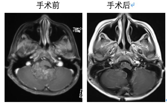 [你的育儿经]儿童脑肿瘤、儿童胶质瘤、儿童型肿瘤的一点见解