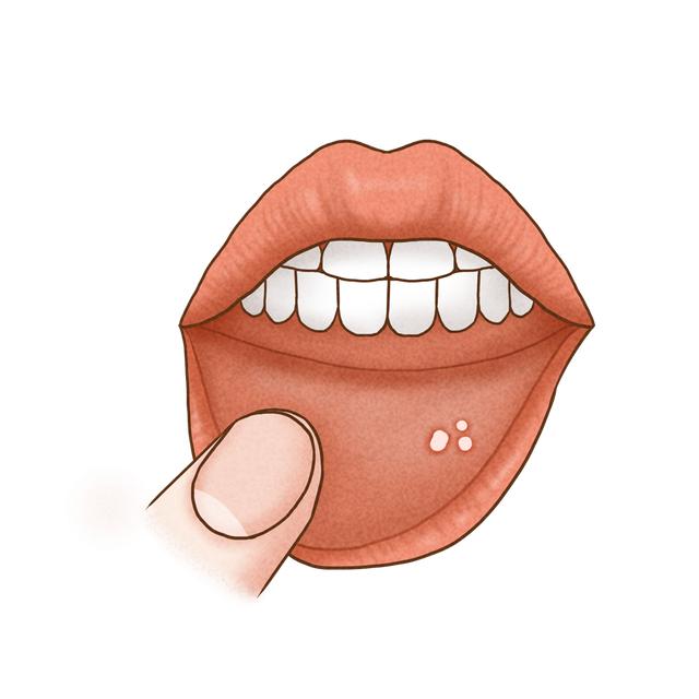 广东男子口腔溃烂，竟被查出癌症！这些坏习惯要不得，快改！