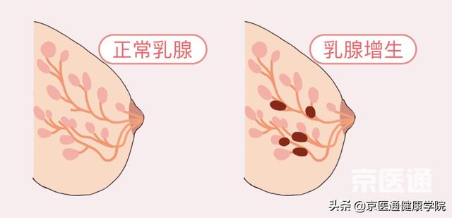 乳腺增生、结节、癌，摸起来什么感觉？医生教你分辨