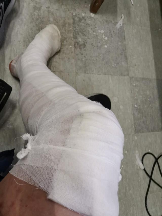刚得知跟腱断裂的我打了石膏回家等到手术.