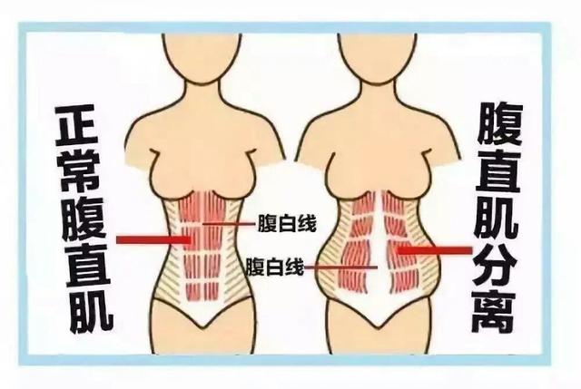 你的育儿经@有一种小别离,叫腹直肌分离!