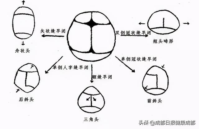 颅腔|2月龄娃长成&quot;方脑壳&quot;，原因竟是……