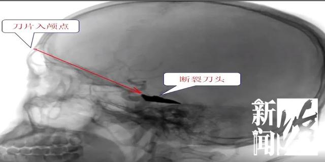 找都找不到！刀片击入男子脑内整两周！来沪就医后发现…