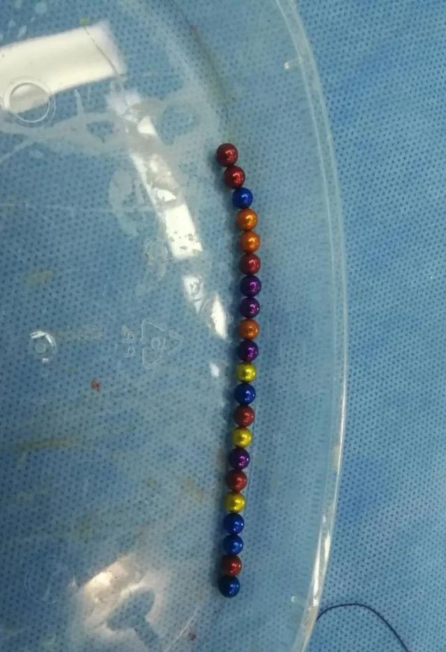 超级宝妈：合肥2岁幼童吞下21颗磁珠，开腹手术做了两个小时