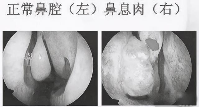 鼻咽癌的元凶，如何检测及防治