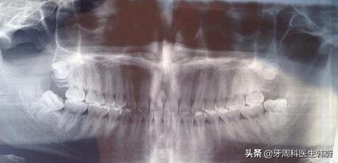 高考生家长们请关注：临考前最容易犯、且严重影响成绩的牙病