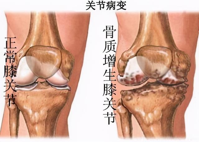 有的人既有骨质增生，又有骨质疏松，这正常吗？