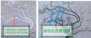 患者|六旬男子急性脑梗死，医务人员上演脑内“