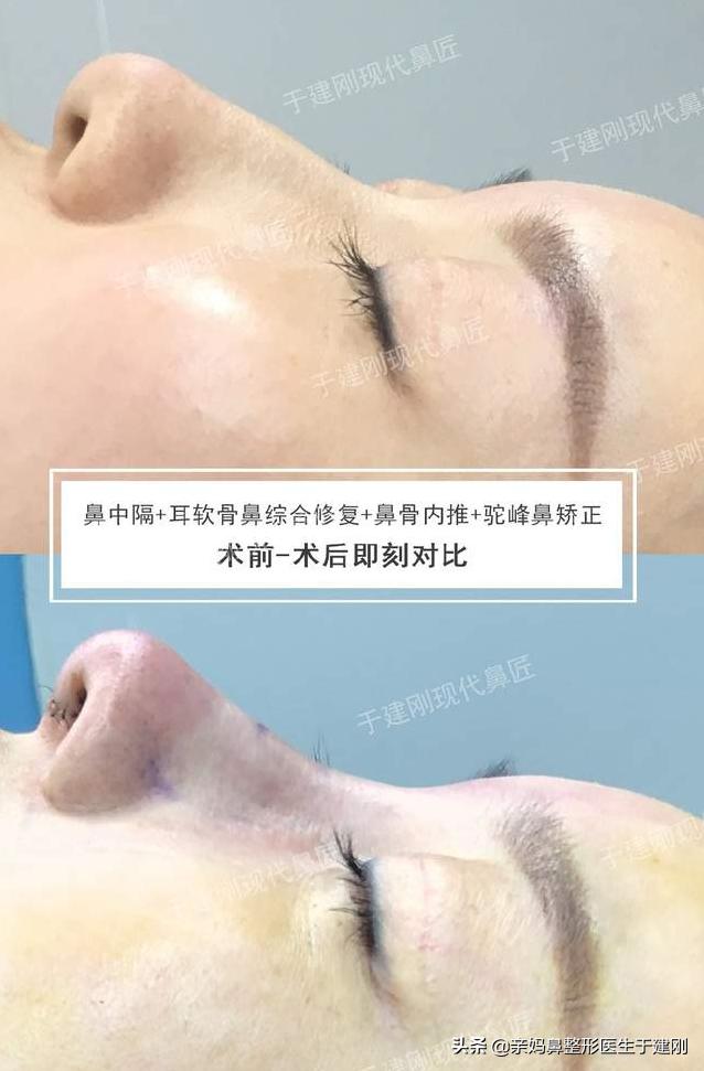 为什么宝妈都爱节假日做隆鼻？看完这篇，原来好处这么多