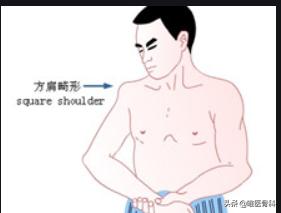 肩膀疼？一个动作，自测是否有肩关节脱位