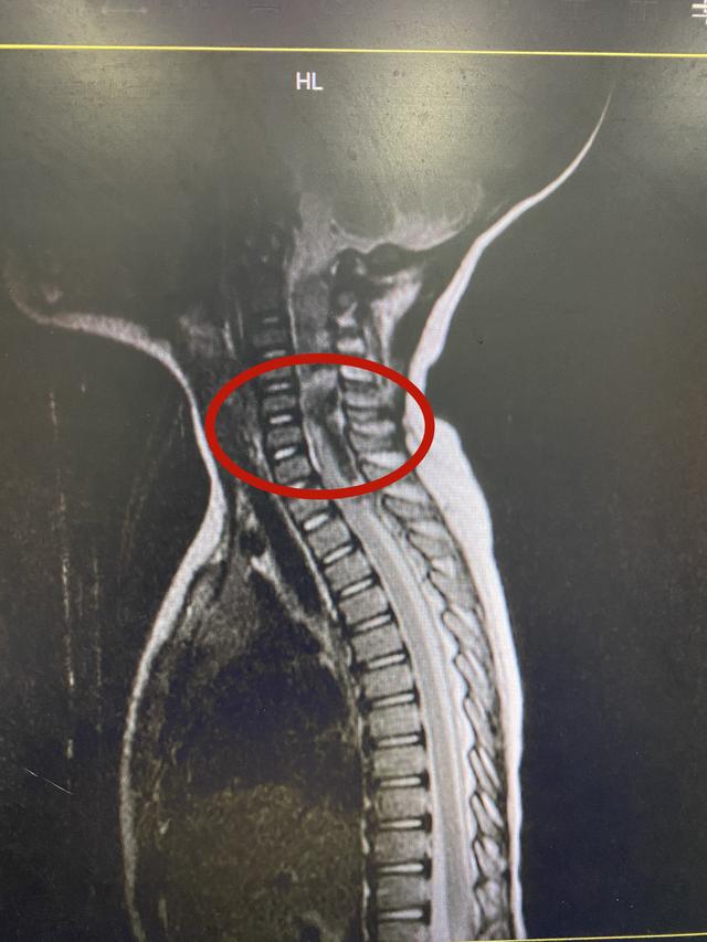 女童高节段脊髓血肿 江西省儿童医院急诊手术