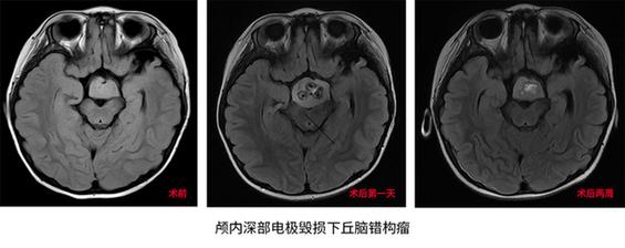 癫痫|3岁女童爱笑性格好？原来是脑内错构瘤！不开颅置入电极根除病灶治癫痫