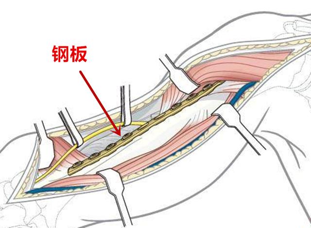 手术|「辟谣」手术是为了促进骨折愈合？错！敷中药往往更能促进愈合