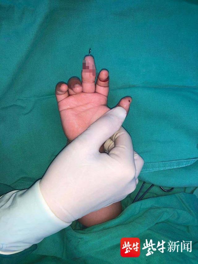 手指|1岁娃玩具切断手指、16岁勤工俭学剪断手指...... 暑期断指事件“高发”