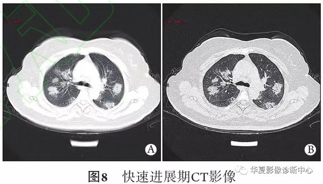 「影像进展」新冠肺炎的CT典型和不典型表现以及影像学分期