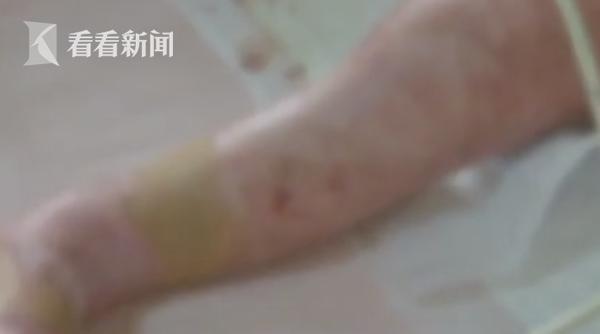 光明网▲1岁女童掉入70℃热水锅烧伤严重 发现时已休克