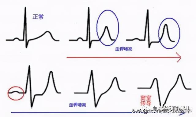 血液净化在急诊的临床应用