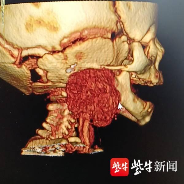 鸡蛋大的恶性肿瘤竟长在两个月宝宝的颈动脉上,南京儿童医院沈卫民