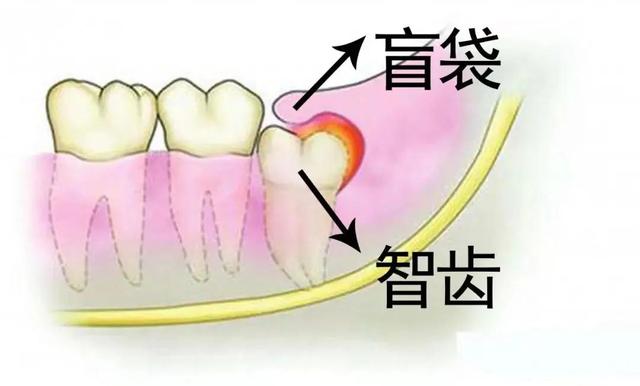 可乐当水喝，一颗小智齿撂倒“英雄汉”，牙疼竟要住院治疗