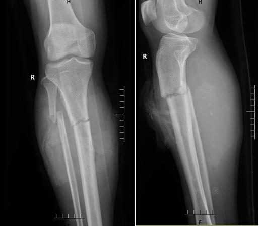 手术|鲁东医院骨科团队妙用钢板外置微创治疗复杂开放性骨折