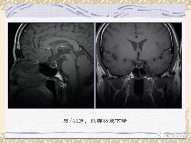 垂体病变的MRI诊断