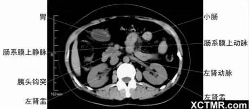 影像解剖：胸、腹部、盆腔CT解剖