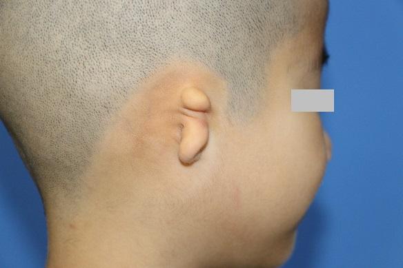 患儿|上海专家升级3D定制全耳廓 同步听力重建