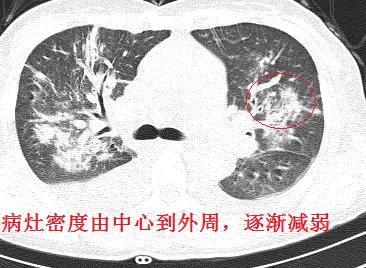 「典型」的肺水肿，为何用抗生素狂轰滥炸？