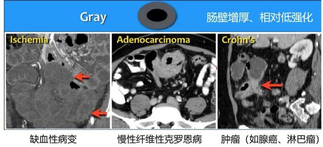 什么是 CT 增强？强化程度、模式、扫描时相等问题逐一解答