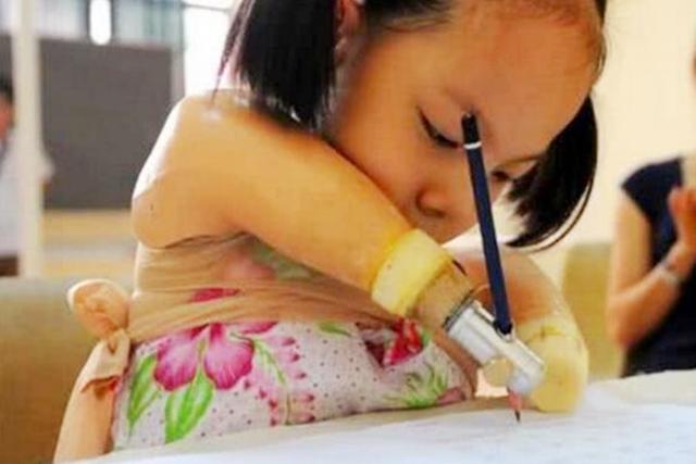 你的育儿经：孕检被检查出没有“手脚”，妈妈依旧生下的孩子，如今怎么样了？
