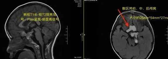 [健康学堂]儿童脑肿瘤易误诊，孩子出现“感冒”“头痛”症状要注意
