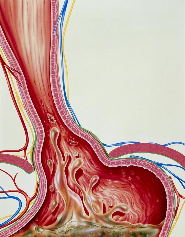 中医治疗胃食管反流病
