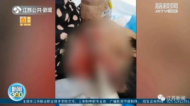 女士|染发有风险！女子染发致头颈部大面积感染