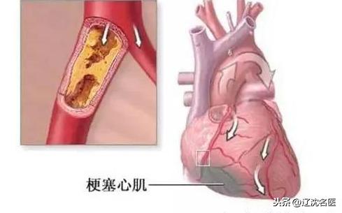 发生急性心肌梗死怎么办？黄金4分钟和两个“120”是什么？