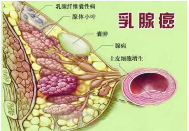 诱发乳腺癌的因素是？如何预防乳腺癌？中年女性喝豆浆有何益处？